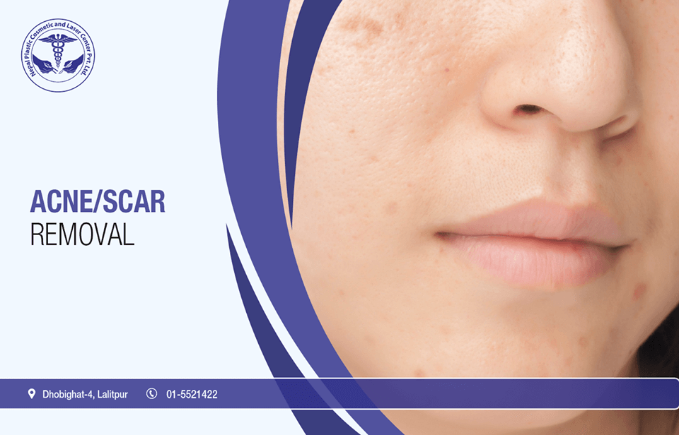 Acne scar removal in Nepal