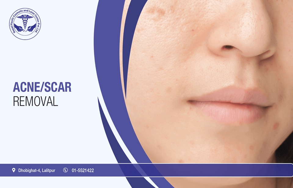 ACNE| SCAR REMOVAL in kathmandu, Nepal