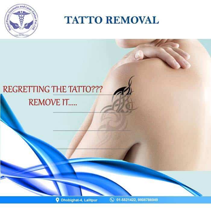 tatoo removal in nepal