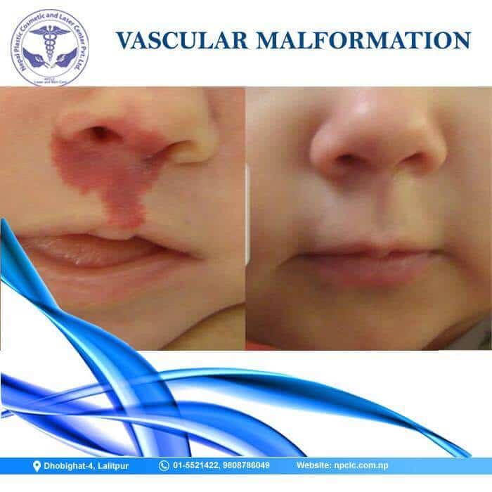 vascular malformation surgery in nepal
