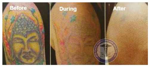 Tattoo Removal in nepal